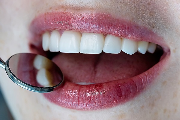 Why You Should Get Cavities Treated With Dental Fillings